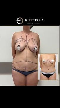 POST-PREGNANCY SURGERY ABDOMINOPLASTY Breast Lift (Mastopexy) #Abdominoplasty #TummyTuck #shorts