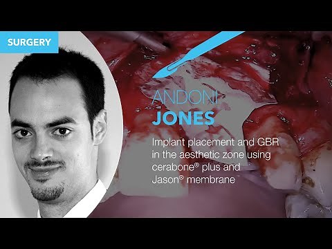 SURGERY: Implant placement and GBR in the aesthetic zone using cerabone® plus and Jason® membrane