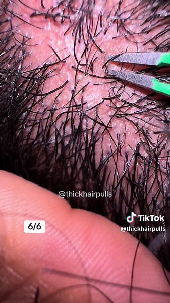 Removing compound hairs from my husband’s beard! 😅 #pilimultigemini #compoundhair #beardplucking #thickhairpulls #pluckingasmr #pluckinghair