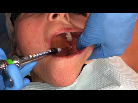 Inferior Alveolar and Lingual Nerve Blocks