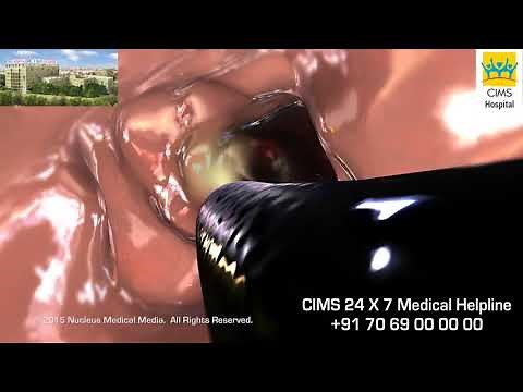 Lower GI Endoscopy (Sigmoidoscopy or Colonoscopy) - CIMS Hospital