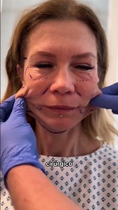 That "windy face" look is a thing of the past! ✨🤭 #facelift #mature skin #skincare