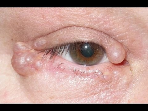 EYE CYST??? #TMITUESDAYS