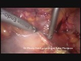 Laparoscopic Resection of Metastatic Nodes After Primary Surgery of Endometrial Cancer  • Video • MEDtube.net