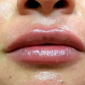 Lip injections #lip #kiss #beauty #juvederm | Lebowitz Plastic Surgery | Facebook