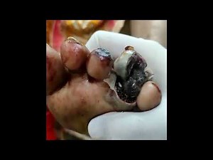 Foot infested with maggots | Surgeon removes worms from a patient’s foot