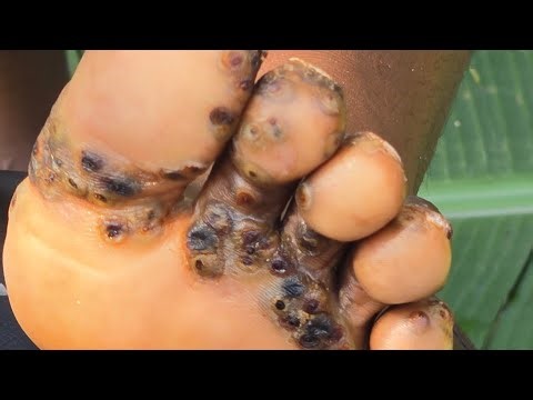 Follow Up Visit with Julius Ombima - still facing jiggers and epilepsy (Jan 25th 2026)