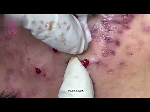 Pimple Popping: Acne So Bad, It Made Me Cry