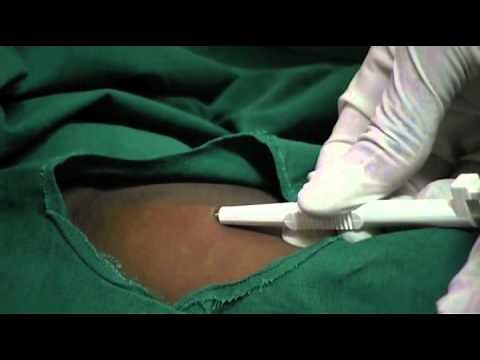 Contraceptive Implants - 11 - Procedure: Insert implant