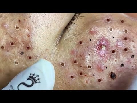 Remove Blackheads and Pimples Popping At Sac Dep Spa #79