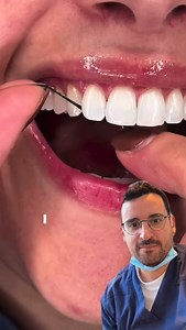 La bonne utilisation du fil dentaire : un geste souvent négligé. Indispensable ou optionnel ? Le fil dentaire est l’un des outils les plus importants de l’hygiène bucco-dentaire, pourtant il reste encore trop peu utilisé ou mal employé. Le brossage, même bien réalisé, ne nettoie qu’environ 60 % des surfaces dentaires. Les espaces interdentaires, eux, restent le refuge principal de la plaque bactérienne. ✨ Pourquoi le fil dentaire est essentiel Entre deux dents, la brosse ne passe pas. Le fil per