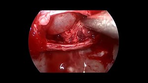 23K views · 107 reactions | Endoscopic Endonasal Pituitary...
