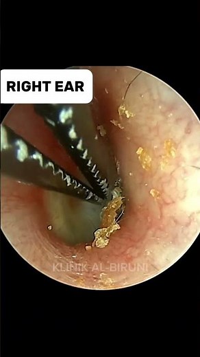 HUGE Beetle Carcass Found Inside The Ear !!!