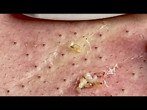 Acne Treatment with Anna Spa #001