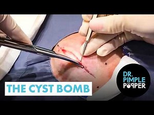 The Cyst Bomb