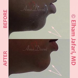 👁 Nonsurgical chin augmentation and enhancement __ 💉 Procedure: Dermal filler injection performed by experienced MD __ 🎯 Purpose: Reshaping chin to correct poorly-defined and underprojected chin and to achieve a more beautiful and balanced look and contour without surgery or down-time __ 💊 Products used: Various dermal fillers can be used, but for best results, we recommend Voluma. The optimal combination of fillers will be determined during your consultation with Dr. Jafari __ 📋 Technique: