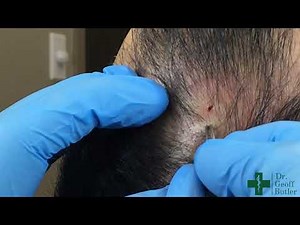Removal of a Pilar Cyst