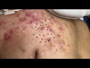 Loan Nguyen Acne Treatment 17hhh