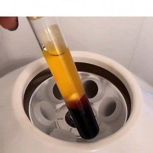 4K views | Vampire Facial aka Microneedling with PRP for anti-aging and acne scars . . This treatment selectively damages the skin in order to promote new collagen growth and remodeling. It improves skin texture & appearance of scars! PRP speeds up the healing process. . . Schedule your appointment today ✔️ | Sofia Skin Studio | Facebook