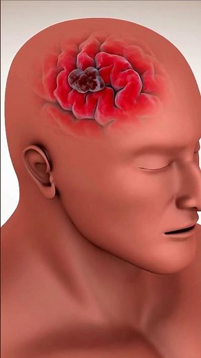 Understanding Aneurysm Clipping in 60 Seconds #AneurysmClipping #BrainSurgery