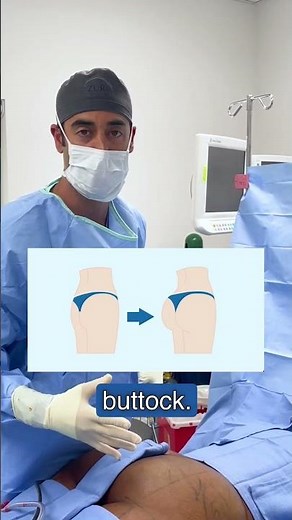 Steps of a Brazilian Butt Lift (BBL) with Dr. Zuri in Miami | Zuri Plastic Surgery