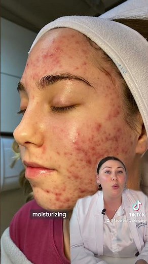 Learn about inflamed acne and the secret to treating it… an Acne Expert😉💧
