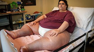 UK’s Fattest Man Dies Of Organ Failure: Here's How Obesity May Cause Organ Failure