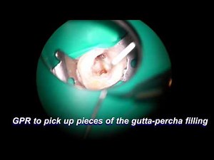 17878 broken file removal with ultrasonics from the start to end real time