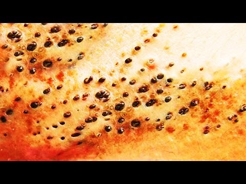 Spreading Blackheads! Rare Footage