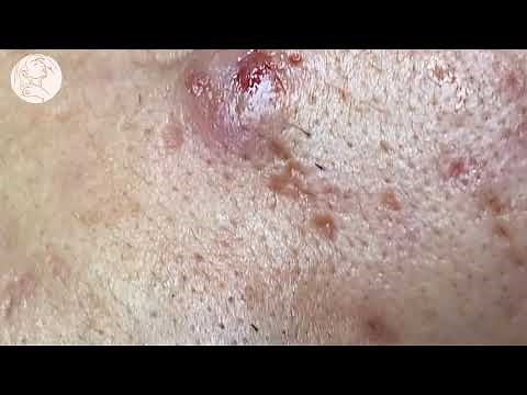 Satisfying And Relaxation with NaSa Beauty Spa #40 blackhead and acne extraction