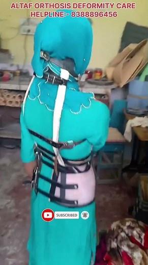 "Milwaukee Brace: A Game Changer for Scoliosis"