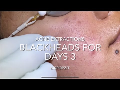 Blackheads for days part 3. 15 minutes of just the pop. Extractions. Blackheads, whiteheads, milia.