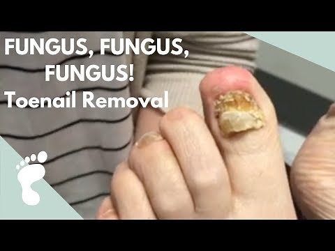 FUNGUS, FUNGUS, FUNGUS! Toenail Removal