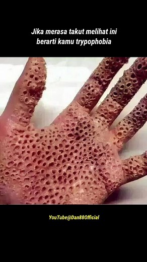 Tripophobia Test: Understanding Fear of Holes