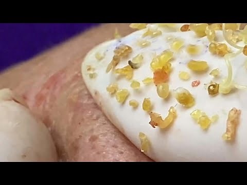 BLACKHEADS REMOVAL // LOAN NGUYEN SPA // April 6, 2021