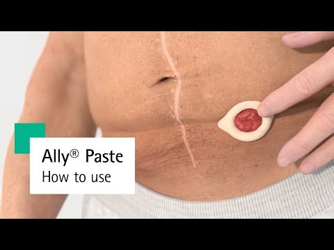 Ally® Paste – Ostomy Paste How to Use