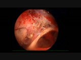 Large Ruptured Dermoid Cyst • Video • MEDtube.net