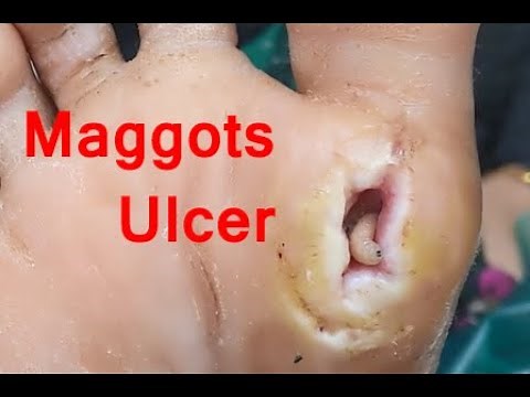 Diabetic Ulcer | Maggots Removal | Diabetic Foot Case Before After
