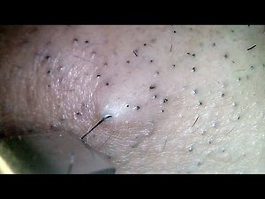 【Zoom Close up Hair Pluck】Pull out the hair that has grown on uneven skin with tweezers