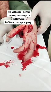 Firecracker explode in boys hand in Kazakhstan