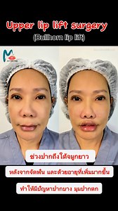 Bullhorn lip lift (Upper lip lift surgery) หลังทำทันที การผ่าตัดยกริมฝีปากบน 🌟🌟ช่วยปรับสัดส่วนใบหน้าให้สวยงาม ดูเด็กลง เปิดริมฝีปากให้อวบอิ่ม ได้ทรงสวย เทคนิคซ่อนไหมแผลเนียนกริบ หมดกังวลเรื่องรอยแผลเป็น by หมอกุ๊ก แพทย์หญิงประภัสรา กิตติธณิกนันท์ Millet clinic, Cosmetic surgery, Dr.Kook ตาสองชั้น เสริมจมูก,คาง ปากกระจับ #ผ่าตัดยกริมฝีปากบน #Upperlipliftsurgery #subnasalliplift #Bullhornliplift #หมอกุ๊ก #มือวางเบอร์ต้นวงการศัลย์ #เนี๊ยบตัวแม่ #แผลสวยกริบ #Milletclinic #มิลเลทคลินิก | Dr.Kook cl