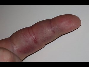 Home remedies for jammed fingers | jammed fingers