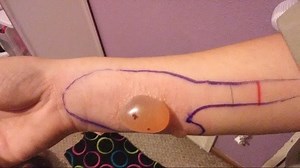 Woman hospitalized after Brown Recluse spider bite