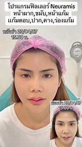 ♥️โปรแกรมฟิลเลอร์ Neuramis ทั่วใบหน้า ♥️ ✅*ผลลัพธ์ที่ได้อาจแตกต่างกันออกไปในแต่ละบุคคล✅ ✅*รูปภาพที่ใช้รีวิวได้รับการอนุญาตเรียบร้อยแล้ว✅ เปิดบริการทุกวัน 12.00-20.00 น.⏰ 🏩 สอบถามเพิ่มเติม ปรึกษา จองคิวได้ทาง 📲 "https://lin.ee/uvB7asK” | KachamasClinic