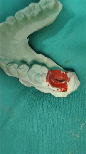 Endocrown / PFM CROWN / Porcelain fused to metal crown / FULL coverage restoration