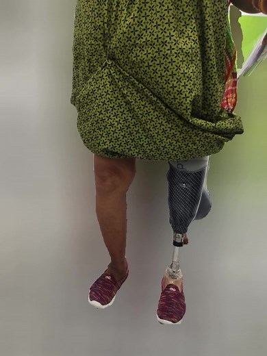 Trans -tibial prosthesis #carbon fibre socket#shuttle lock#color fabric@humanoid Rehab clinic@patna | Aryan Sujeet