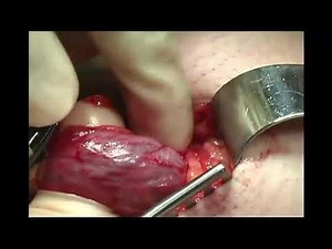 The Technique of Radical Orchiectomy