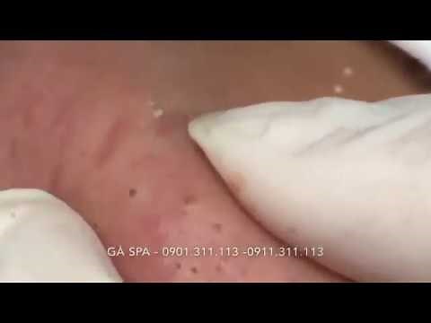 Highlight Professional blackhead popping at its best - GÀ SPA