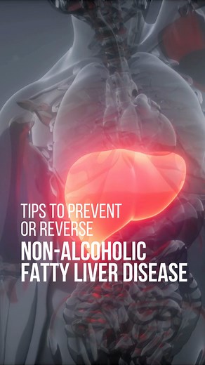 1.7K views | Non-alcoholic fatty liver disease (NAFLD) is a condition where excess fat accumulates in the liver, not caused by alcohol consumption. It can often be managed and, in some cases, reversed through lifestyle changes. Here are some tips to prevent or help reverse NAFLD. #nonalcoholicfattyliverdisease #NonalcoholicFattyLiver | Kokilaben Dhirubhai Ambani Hospital, Navi Mumbai | Facebook