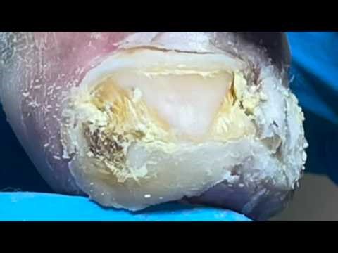 Plantar Warts Are Contagious; Remove Dead Skin Step By Step!【Pedicure Master Lin Jun】